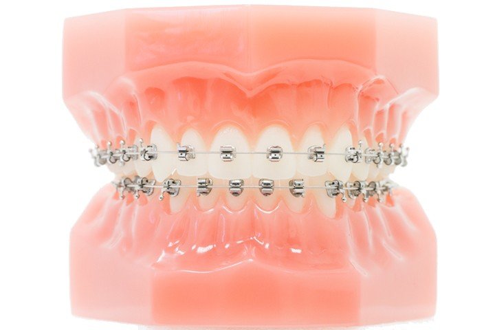 SPEED System Orthodontics